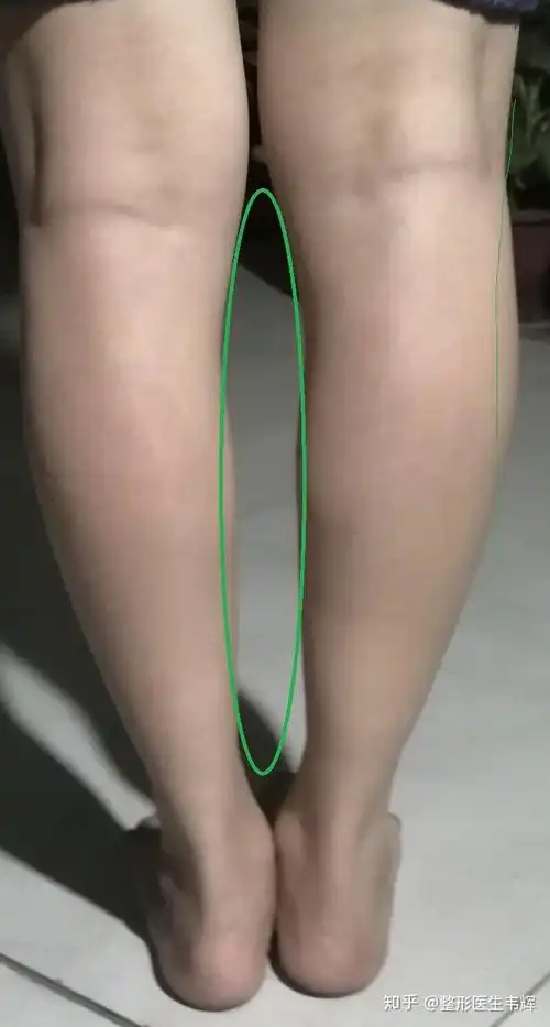 姐妹们这种肌肉腿怎么瘦啊我是不是小腿外翻