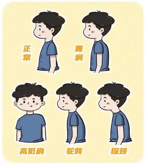 当心脊柱侧弯在"搞鬼"_姿势_特发性_家长
