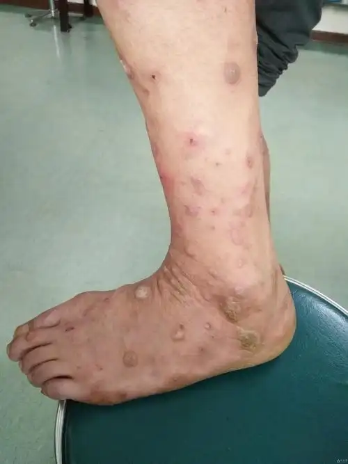 典型病例——结节性痒疹 - 皮肤及性传播疾病讨论版 - 爱爱医医学论坛