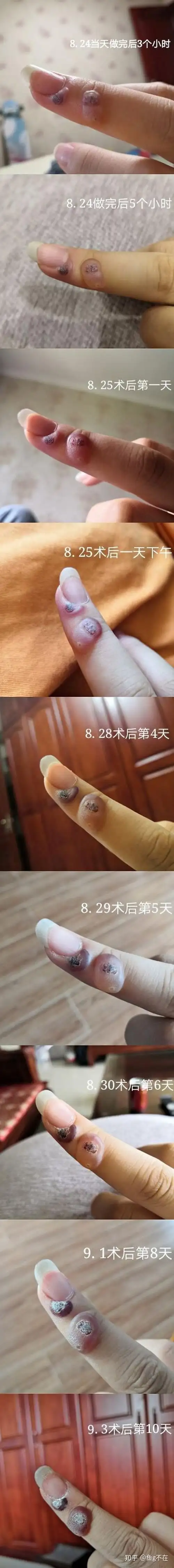 液氮冷冻治疗疣有图有真相是亲身的经历