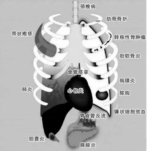 救心丸也无法缓解胸痛罪魁祸首原是肺癌