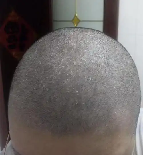 大块大块地掉头皮屑,有什么好用的去屑洗发水推荐?