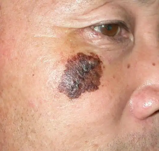 大仙我这颗痣当不当点?