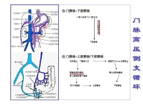 ⑤ 门静脉–下腔静脉    ⑥ ⑥ 门静脉–上腔静脉/下腔静脉 门 脉 高