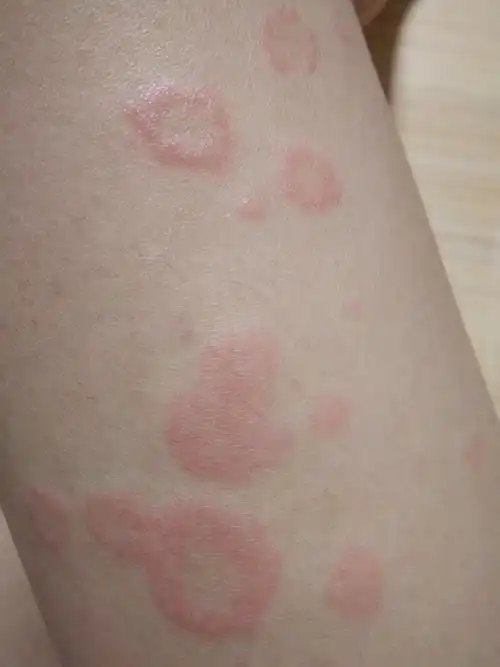 皮肤病两三年了,月经前两天手上脚上起疙瘩,上个月皮肤起风团去