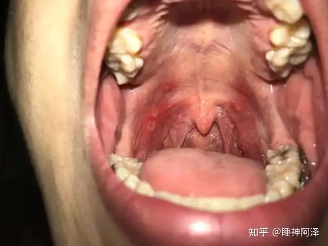 你们感觉口腔溃疡长在嘴里的那哪个位置最折磨人 ?