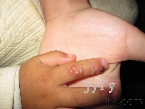 欢庆元旦-疱疹性瘭疽