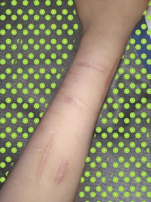 你身上疤痕的故事