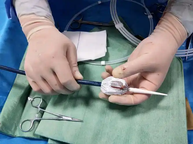 巨大主动脉夹层动脉瘤并小弯破口开槽支架腔内隔绝术 州医 骨四