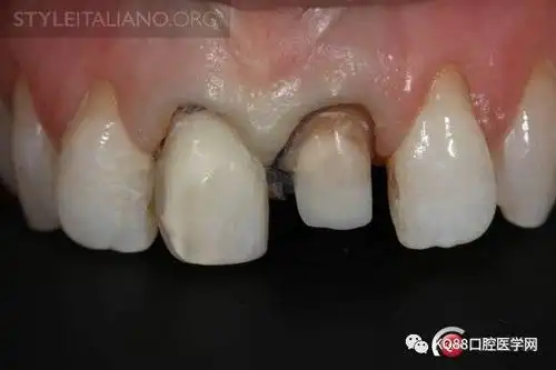 前牙金属桩核处理案例