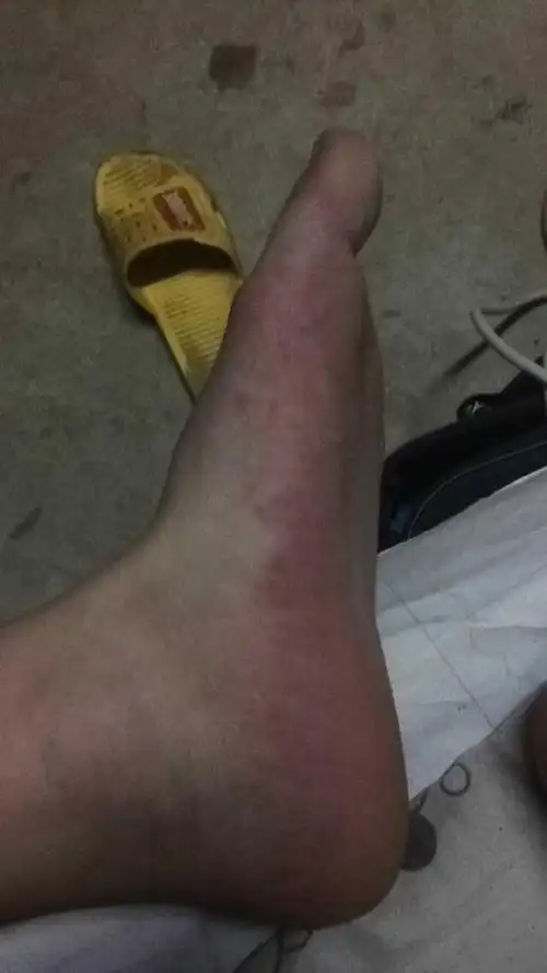 由于我们每天有大量的运动,所以我的一些队duì友也都出现脚汗多脚臭