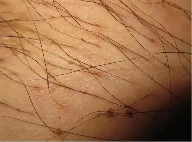 男子腹部痒医生用镊子夹出16只阴虱原来阴虱有4个传播途径