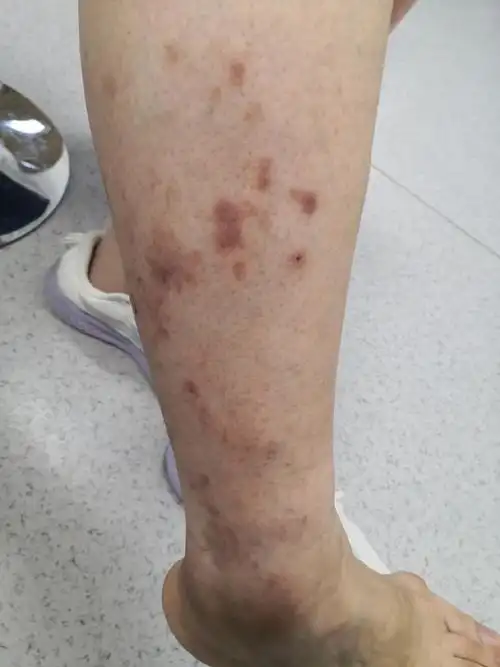 右侧小腿部位红斑丘疹症状.皮炎症状,要排查一下真菌感染引起的体癣.