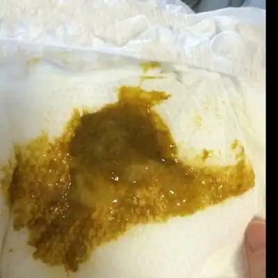 宝宝半岁了,腹泻半个多月了,化验大便都正常,半夜闹腾肚子疼,摸着肚子