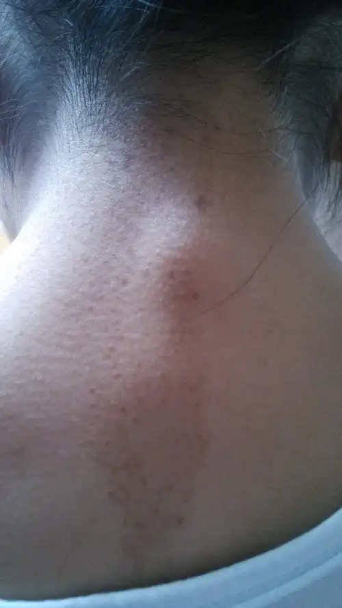 颈部长的是什么斑