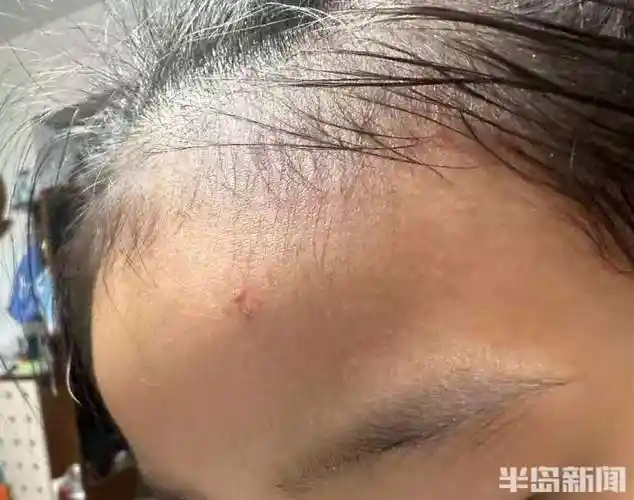 吃烤肉蹦出火星5岁女童脸上被烫伤