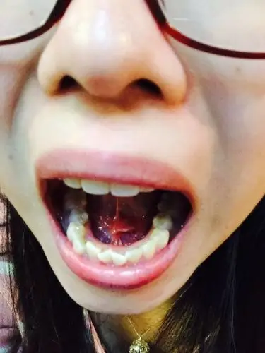 舌根处有个肉疙瘩.