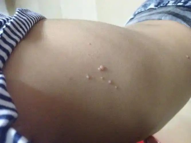 宝宝身上长这绿豆大的肉痣,小时候没有的!