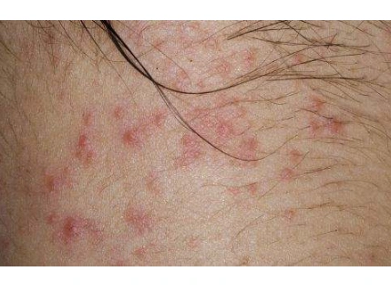 过敏皮炎症状图片61