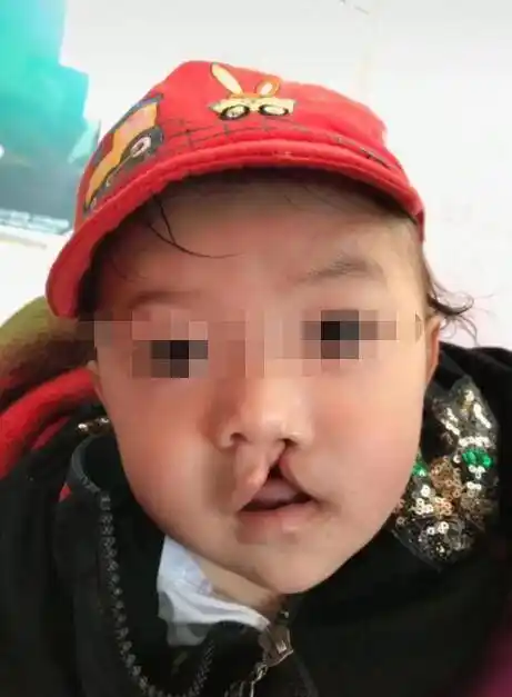 原创兔唇是咋形成的组图清晰展示三种妈妈易中招一种跟爸爸有关