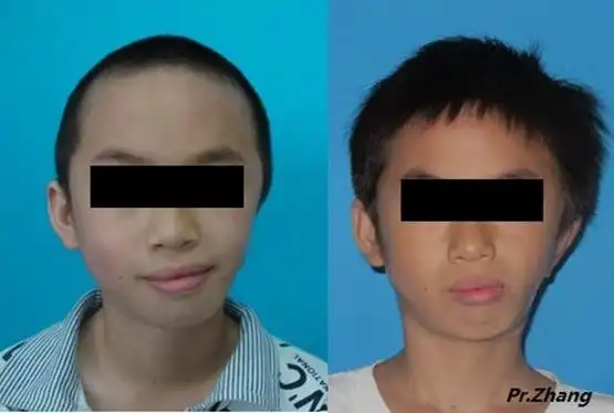 咬合平面及口角歪斜术前术后对比照片术前术后斜位照片半侧颜面短小