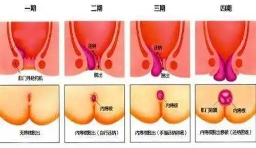 安全无痛便捷治疗内痔新模式一一经内镜内痔聚桂醇注射