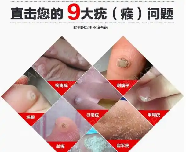 寻常疣,扁平疣都是hpv感染,那会不会得尖锐湿疣,甚至宫颈癌?