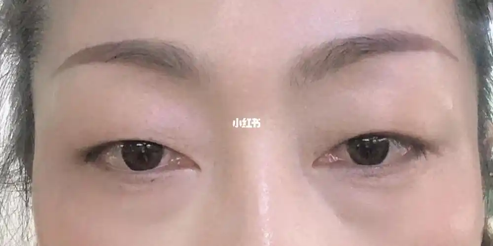 内眼角泪阜暴露过多割双眼皮不知道好不好看