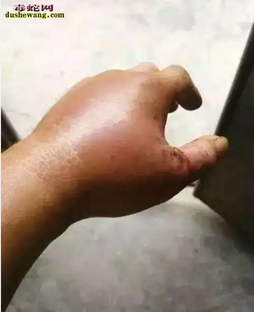 被蛇咬伤图片,被蛇咬伤各种症状图片大全_蛇的图片_毒蛇网