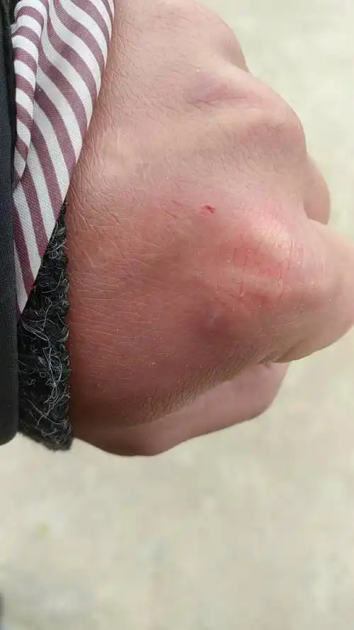 被狗狗牙齿刮伤,伤口像米粒大,挂伤后出了两滴血,要不要打针