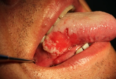 口腔这样的溃疡要警惕!