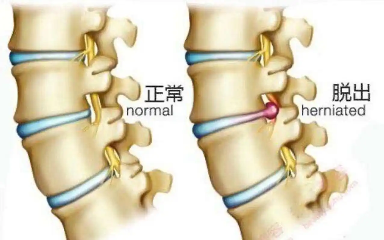 腰椎间盘突出,腰不痛了腿不麻了,就是腿脚酸痛,是不是快康复了#动态
