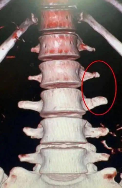 腰椎横突骨折严重吗?告知你不了解的骨折真相_治疗_活动_腰部