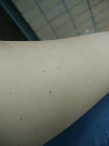 我是乙肝携带者就是手臂上痒一抓就有小红点,就是皮层里面小小的,身上