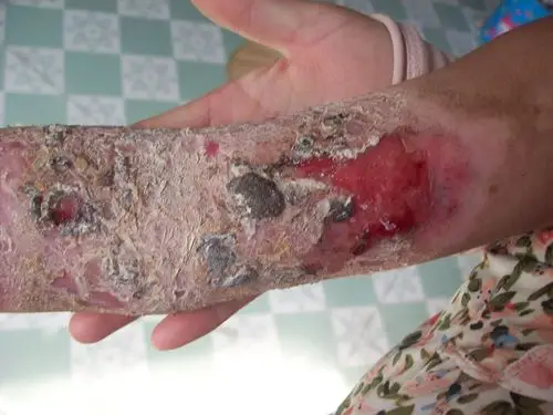 大家好我们家孩子三岁半了,从烫伤到现在,已经,四