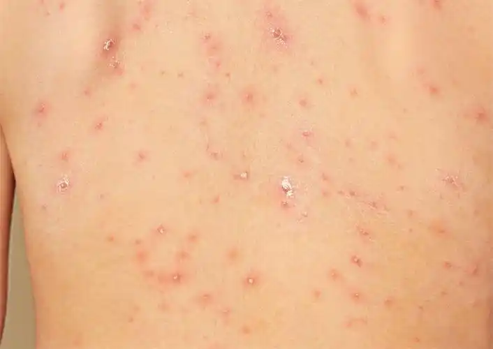 嘴上起小水泡图