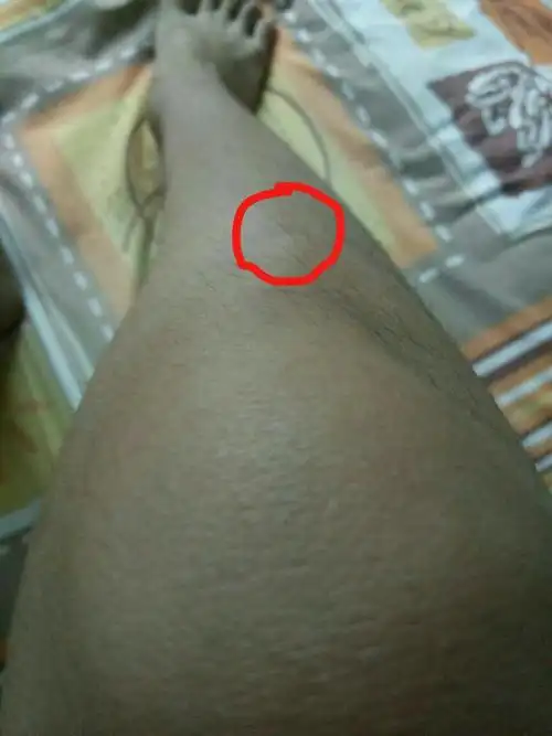 膝盖前突出一块黄豆大的小骨头最近发现右腿膝盖前"胫骨粗隆"那里明显