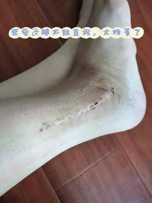 不知道是不是心里作用,抓痒的过程,感觉摸着都能感觉到钢板硬硬的,是