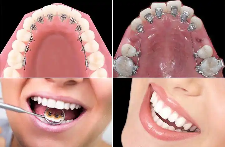 牙齿矫正最低多少钱?