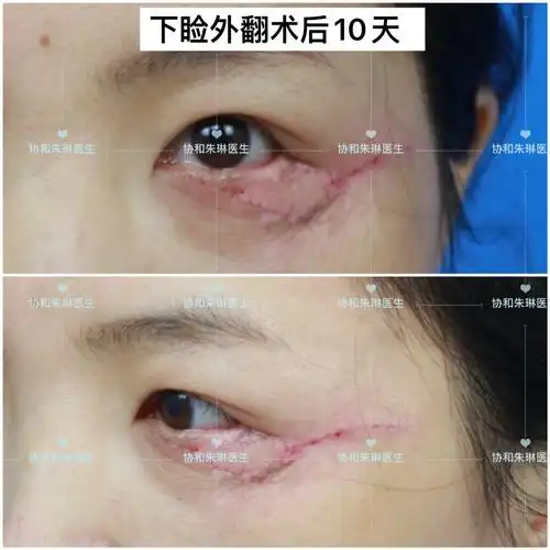 下睑外翻,应该怎么修复,长期效果怎样?