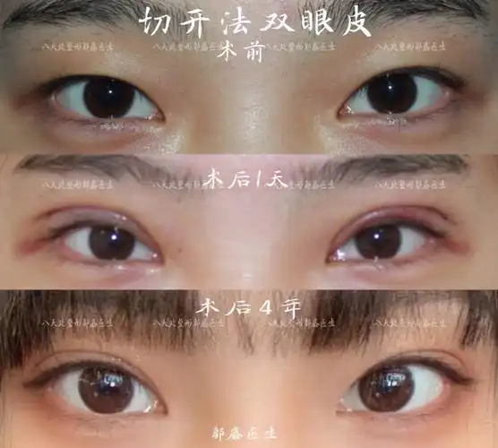 全切双眼皮,开内外眼角,提肌缩短(郭鑫医生)_双眼皮手术_双眼皮手术