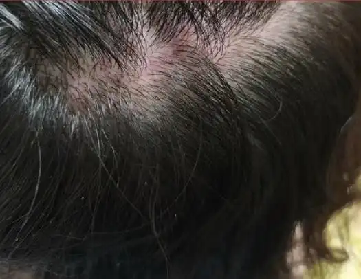 除螨虫必看皮肤红肿又疼又痒饱受螨虫困扰螨虫怎么去除一个月除螨虫