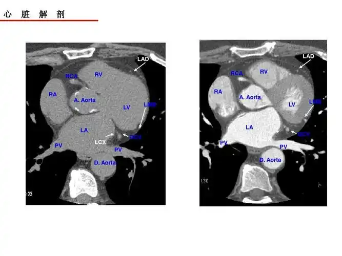 心脏ct解剖ppt