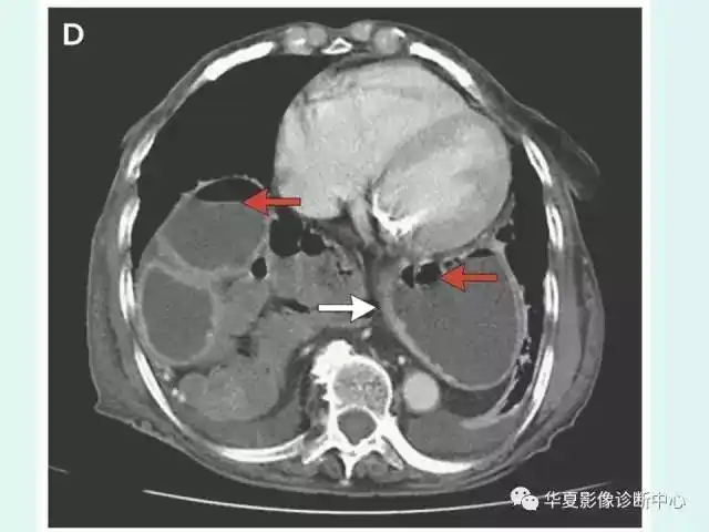 食道裂孔疝1例影像表现