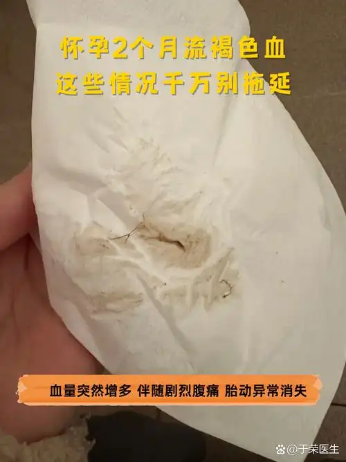 怀孕2个月流褐色血,这些情况千万别拖延