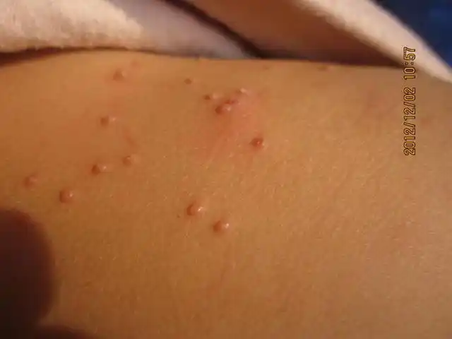 宝宝得了传染性软疣怎么办宝宝长了传染性软疣怎么办