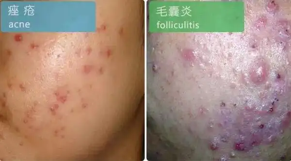 痤疮和毛囊炎有差异切勿混淆