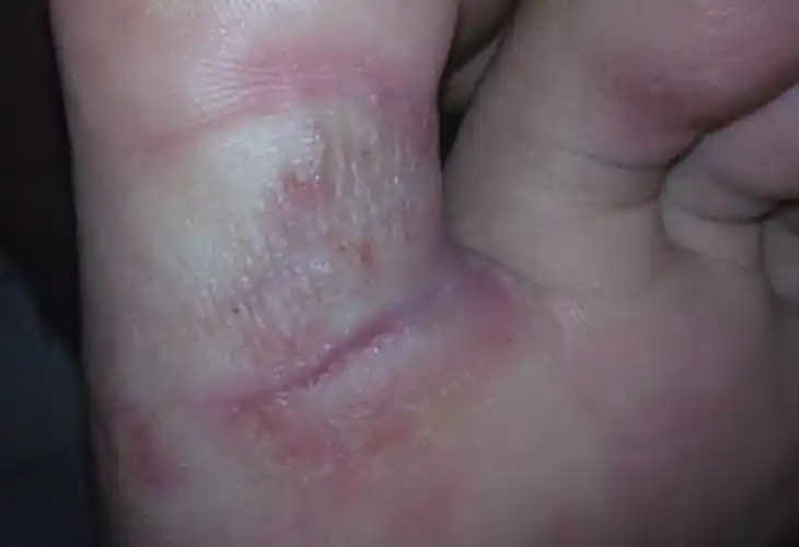 真菌性脚藓的图片