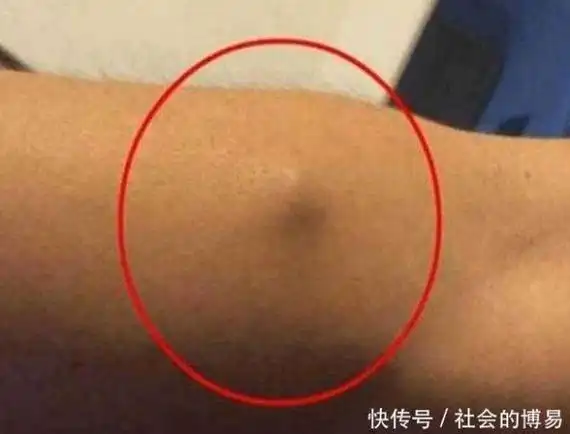 小伙手上长了一个包以为是肿瘤开刀取出来的东西医生不淡定了