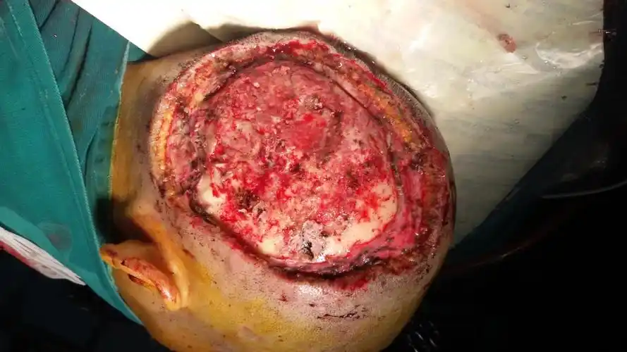 头皮鳞状细胞癌